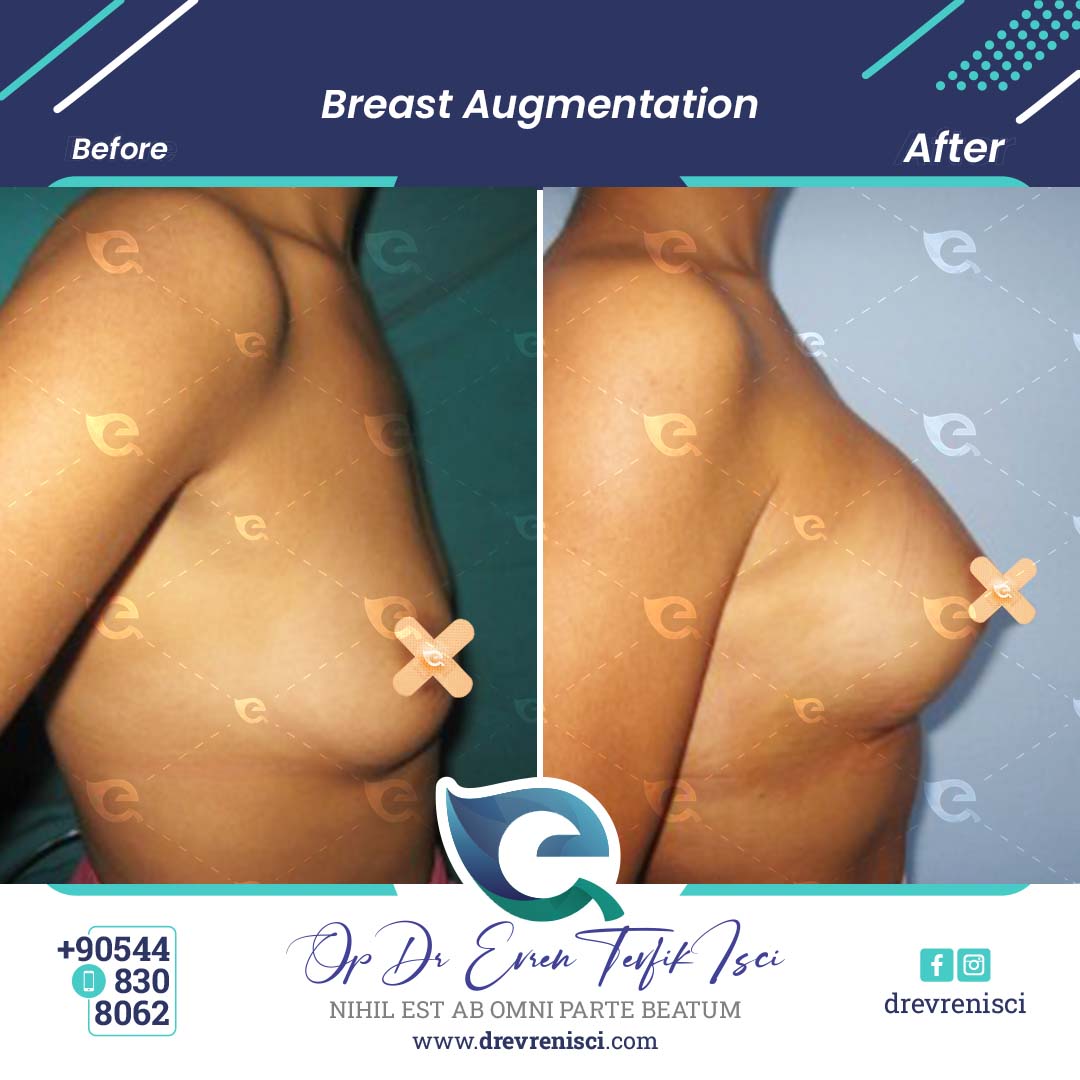 breast augmentation gallery 1
