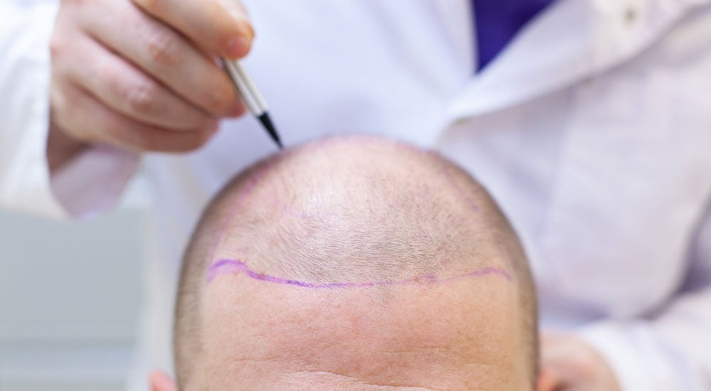 what causes redness after hair transplantation?